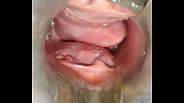 Frisk Prolapse vaginal min Tube